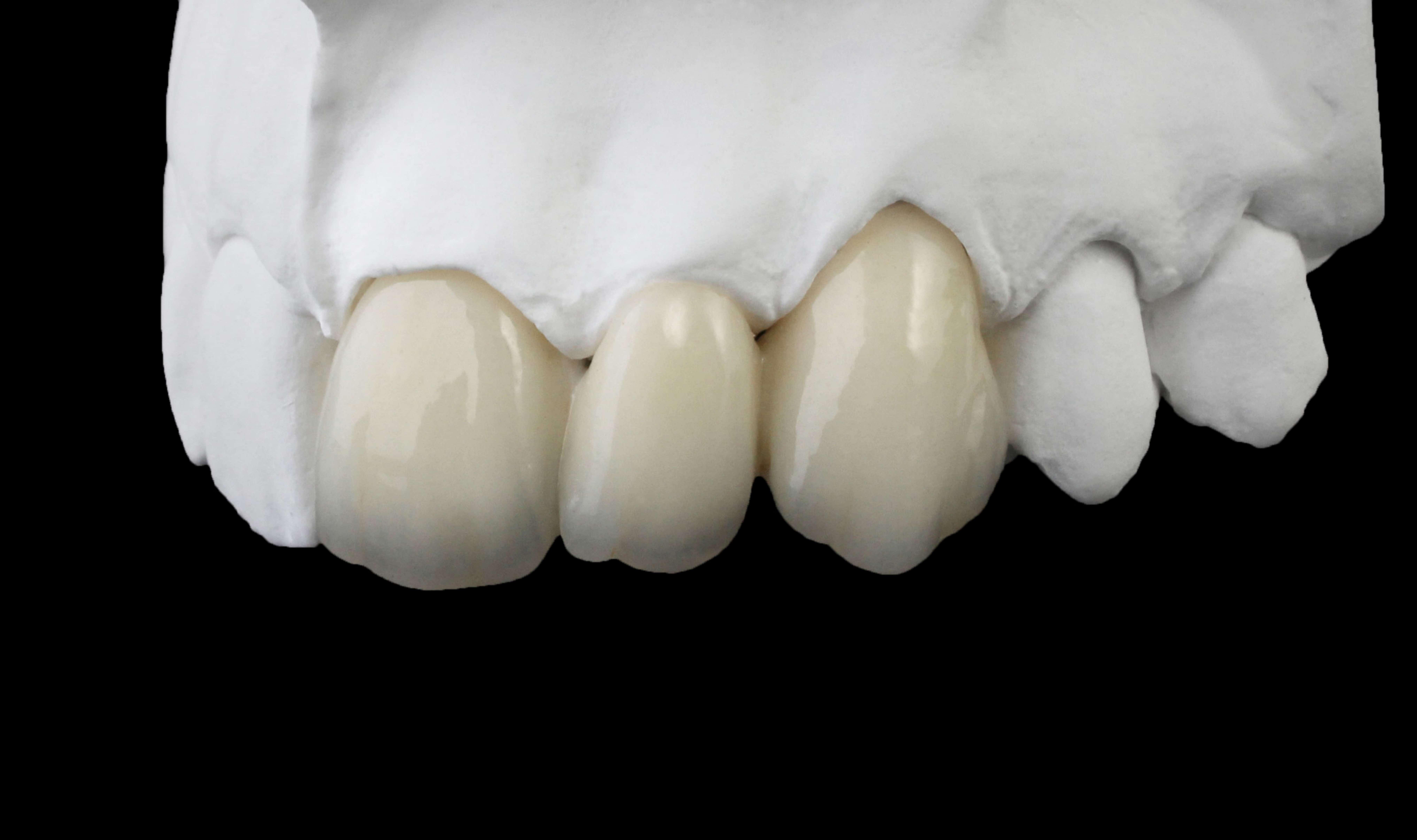 Layered Zirconia