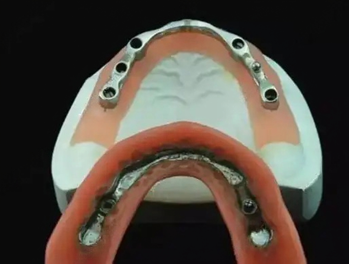 Implant-Retained Overdenture With Bar Attachment